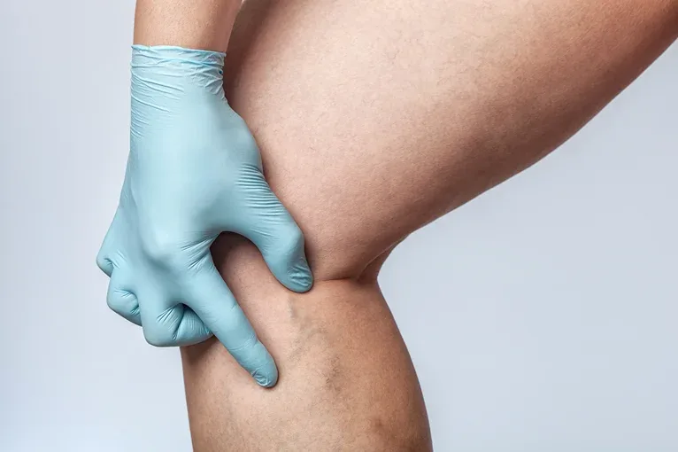 Gloved hand holding a leg with chronic venous insufficiency