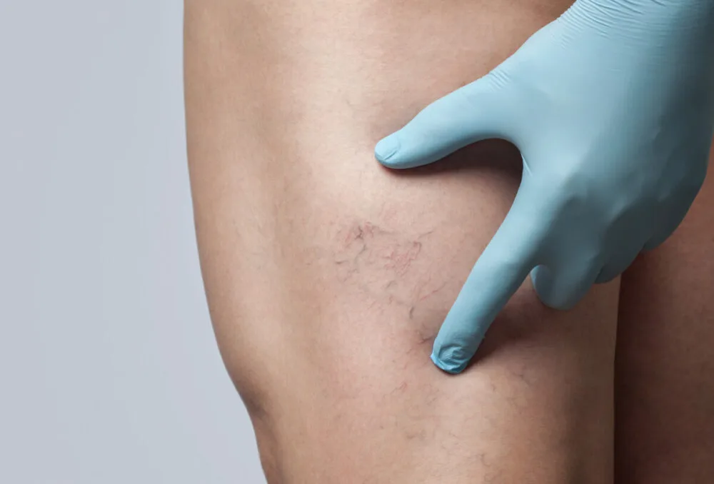 Can Chronic Venous Insufficiency Be Reversed?