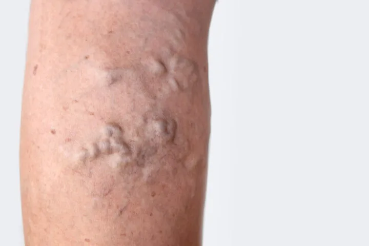 What Causes Varicose Veins in Inner Thigh?