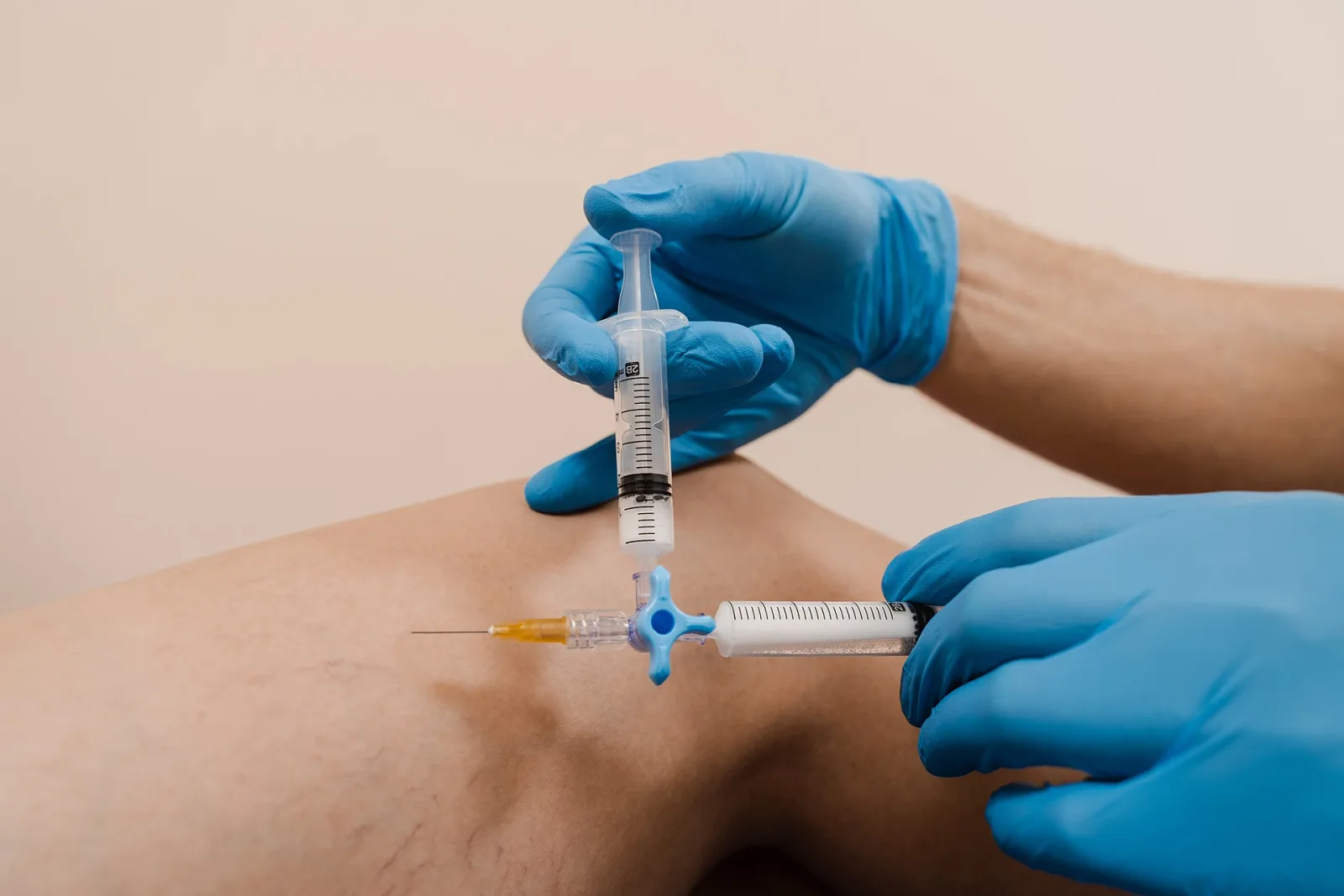 Spider Vein Injections After Varicose Vein Surgery