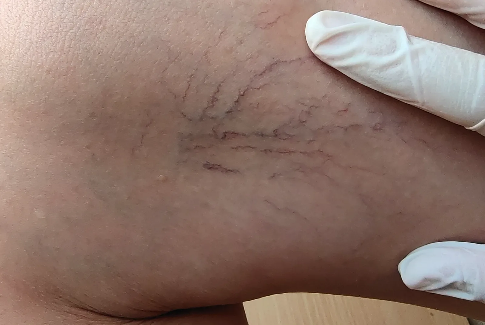 Can I Get Rid of Thread Veins at Home?
