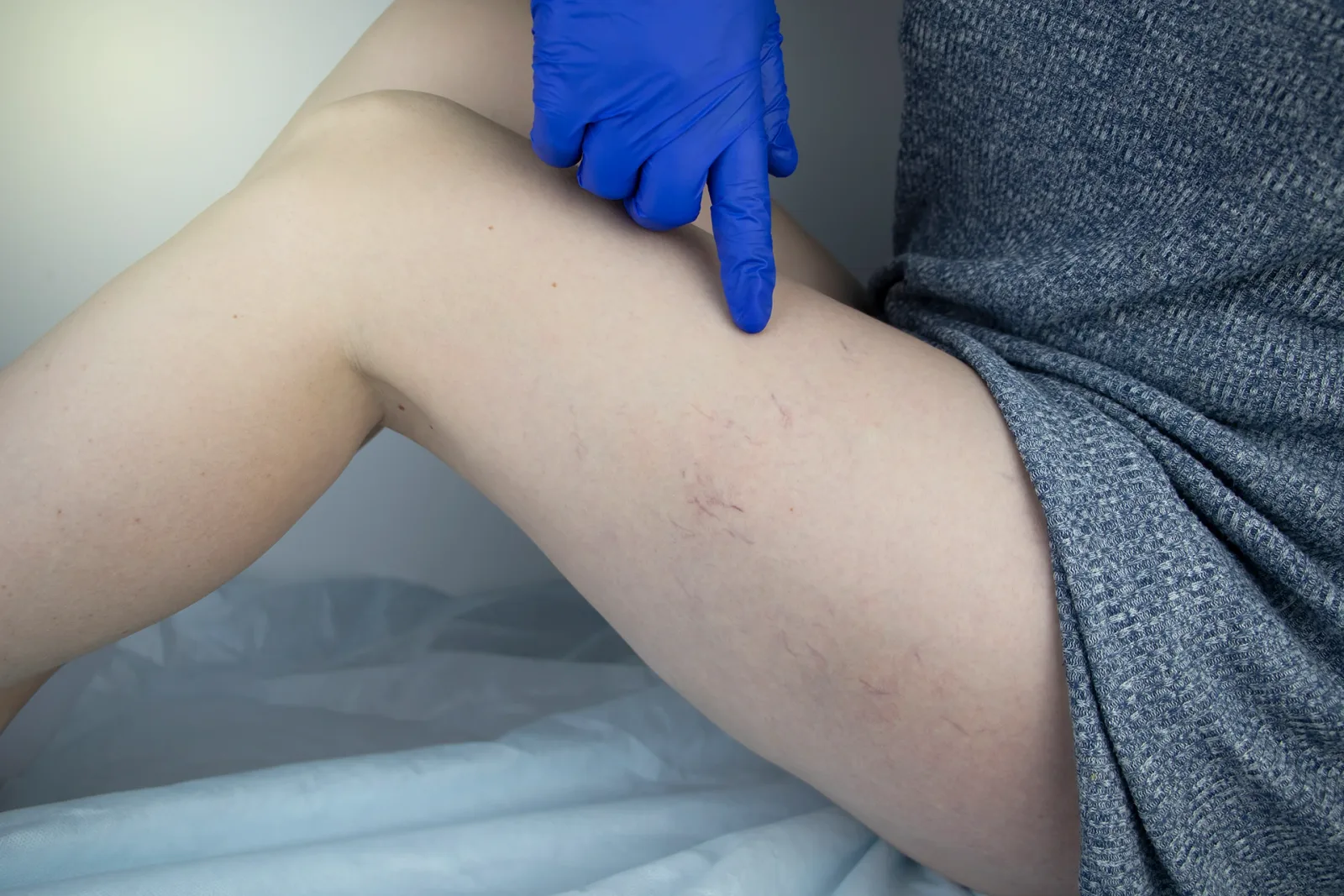 What Happens When You Don’t Take Care of Varicose Veins?
